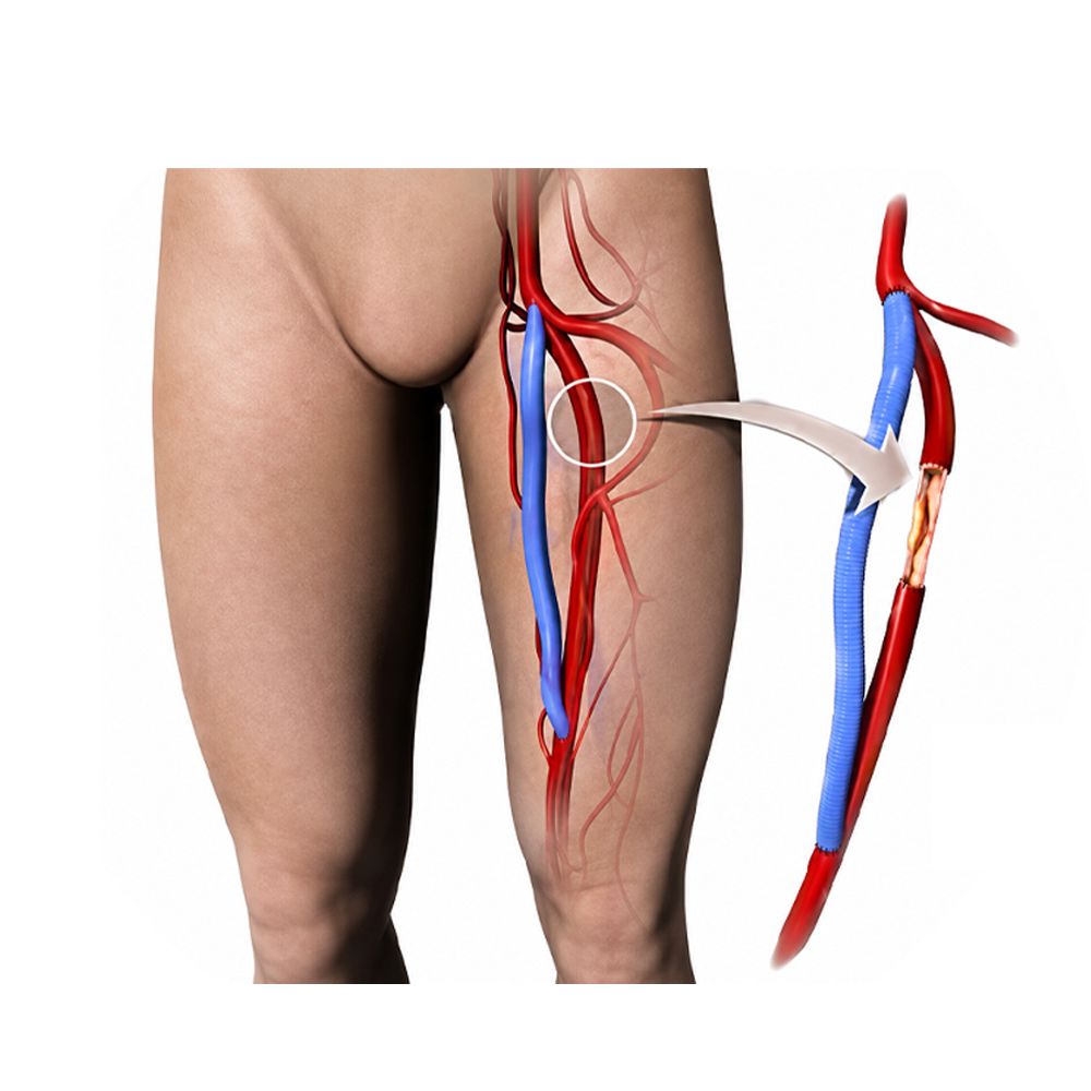 Vascular Surgery